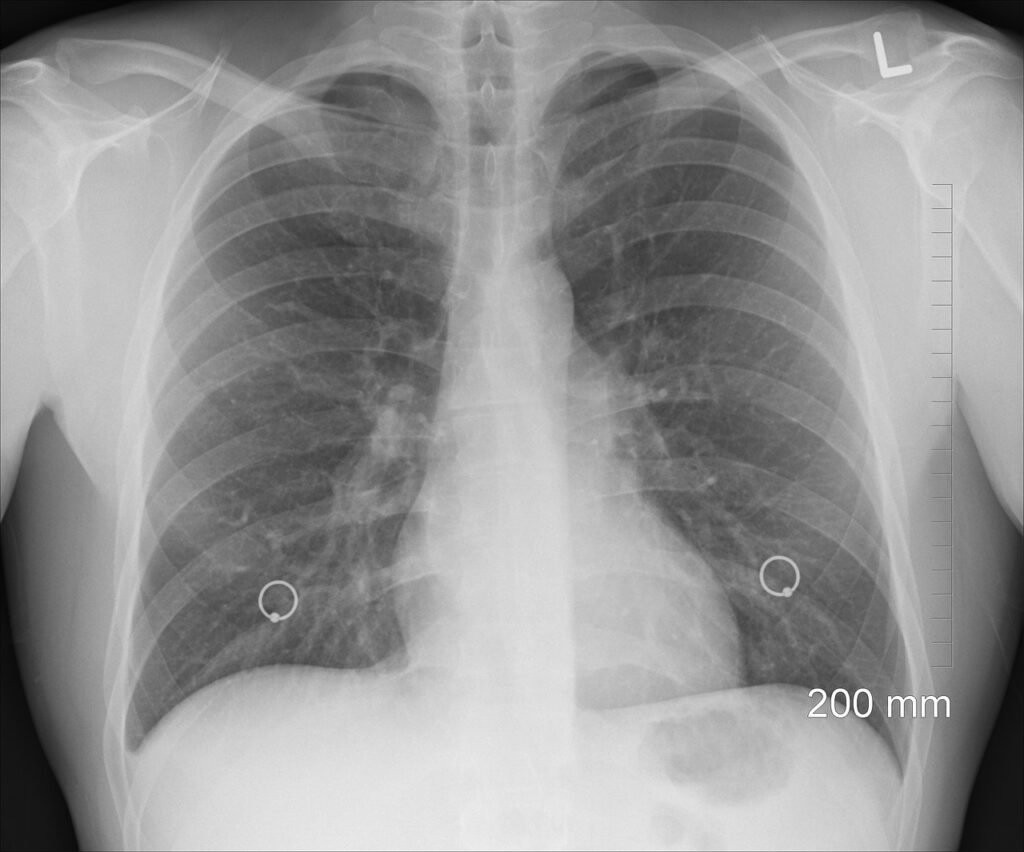 diagnosis, xray, chest, lungs, ribs, body, human, organs, bone, medicine, nipple rings, gray medicine, gray body, gray human, xray, xray, xray, lungs, lungs, lungs, lungs, lungs