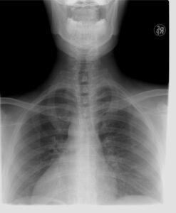 xray, thoracic spine, diagnosis, xray, xray, xray, xray, xray